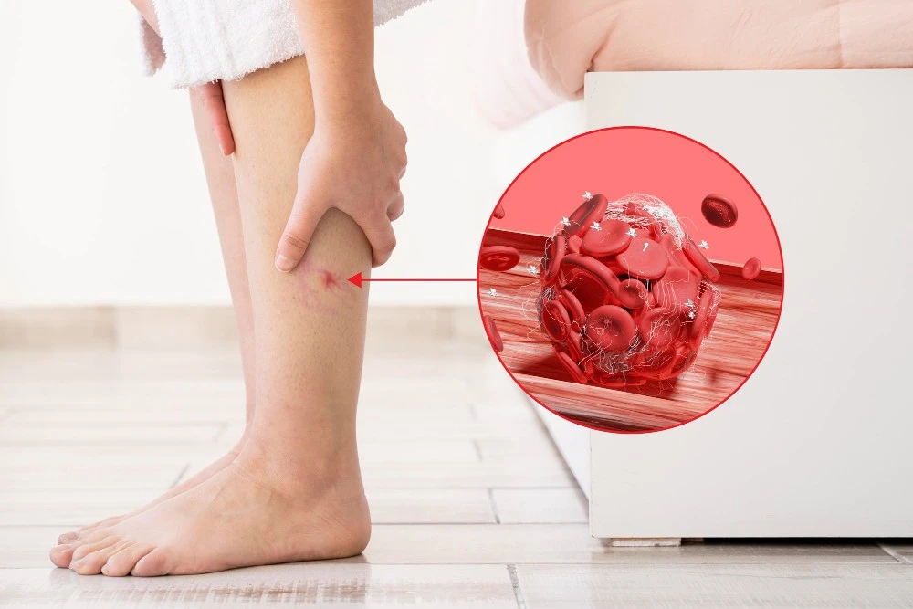 blood-clots-legs-disease
